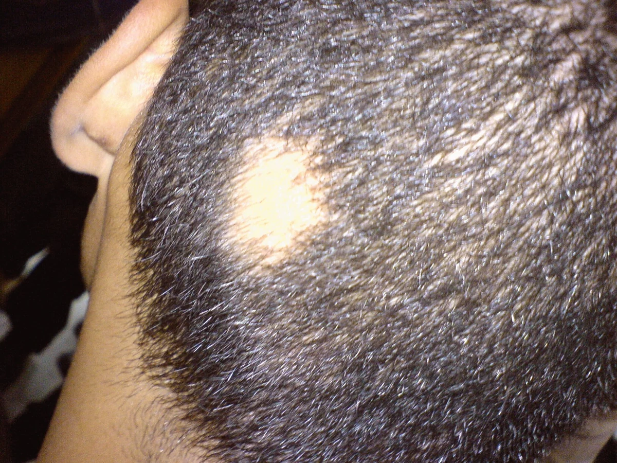 Real scalp photograph showing a distinct localized patch of hair loss identified as alopecia areata